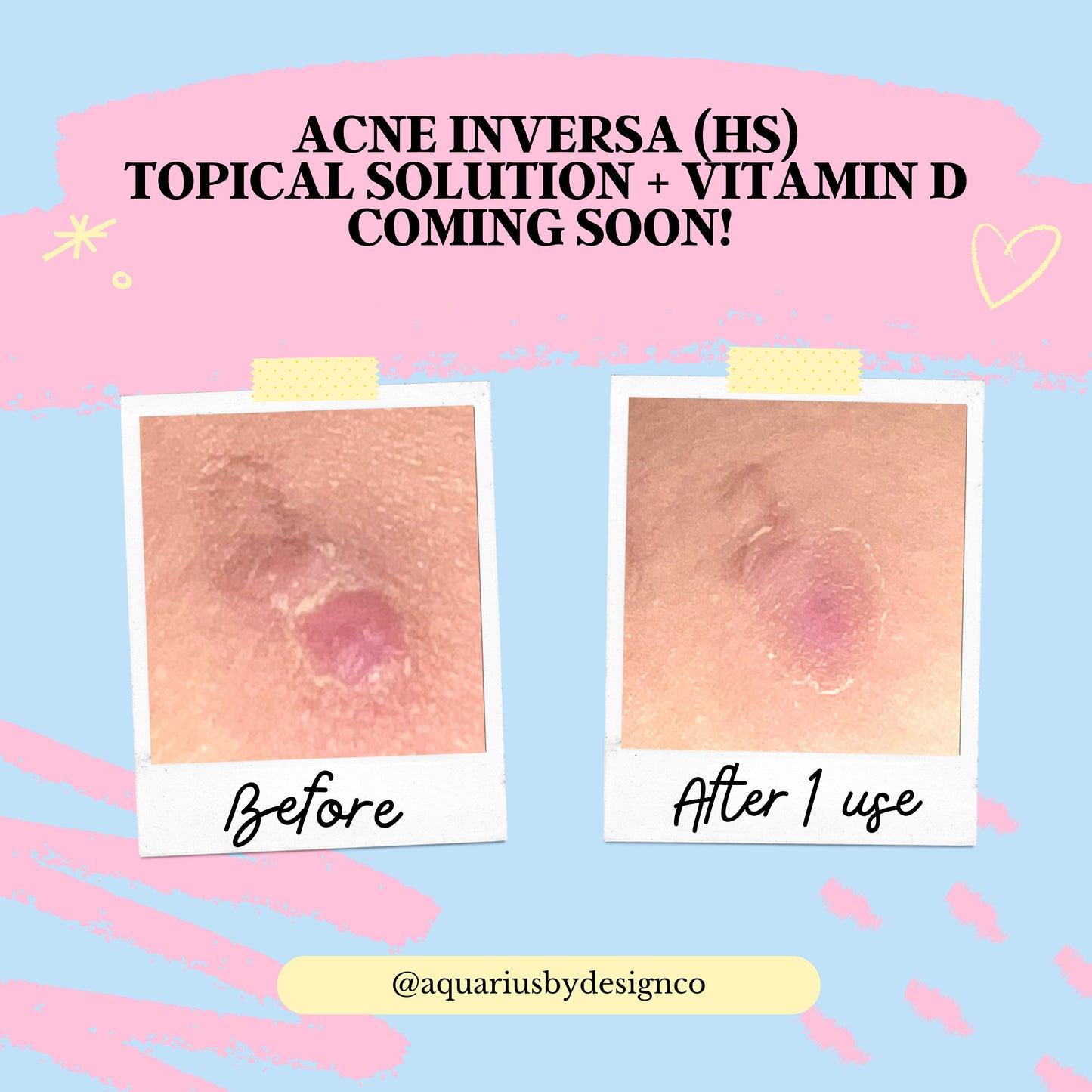 Acne Inversa Topical Solution Calming Gel